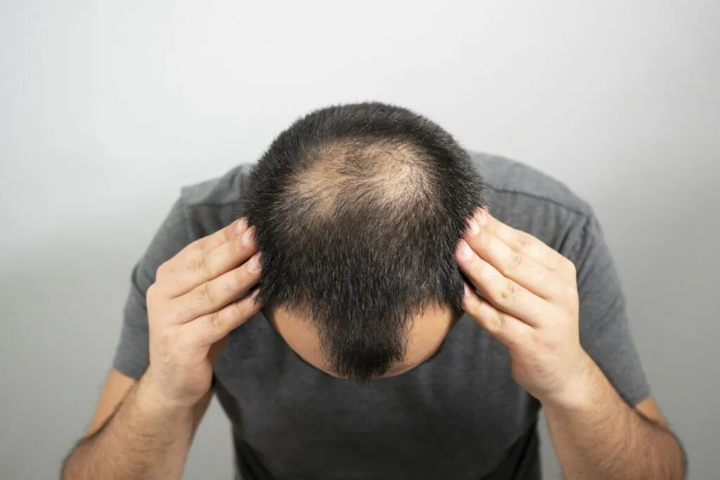 Genetics (pattern baldness)