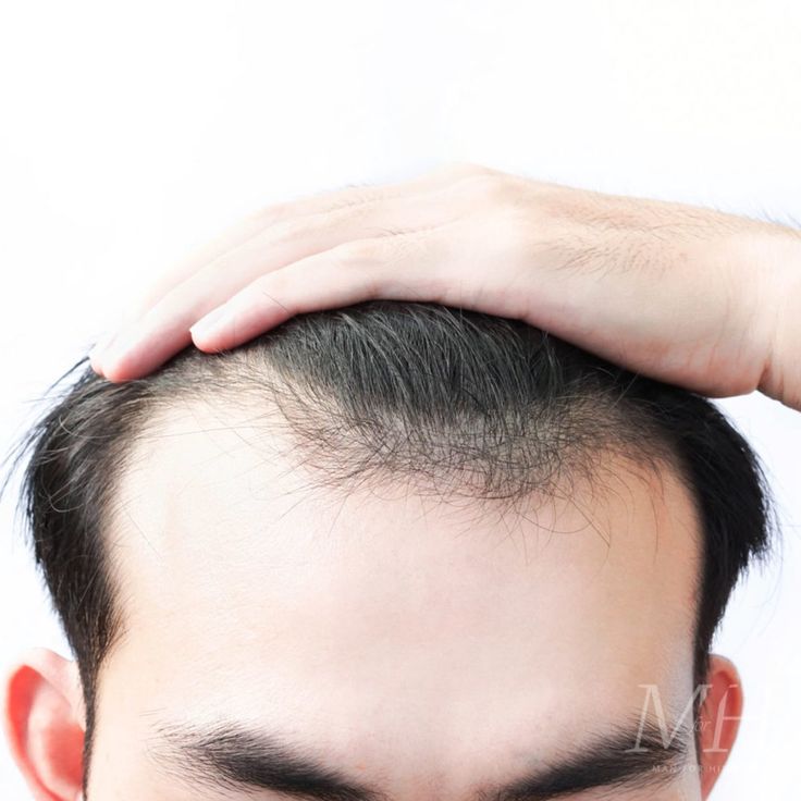 create realist image Is It Normal To Lose Hair While Showering or Brushing?