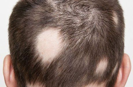 Natural Treatments for Alopecia 1 ALOPECIA