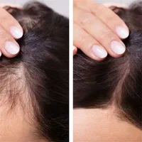 Male vs Female Hairline 4 Before and After Female Celebrities Who Battled Thinning Hair