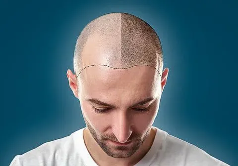 Natural Cure for Alopecia: Evidence-Based Remedies That Work 2 Does Hair Transplant Hurt
