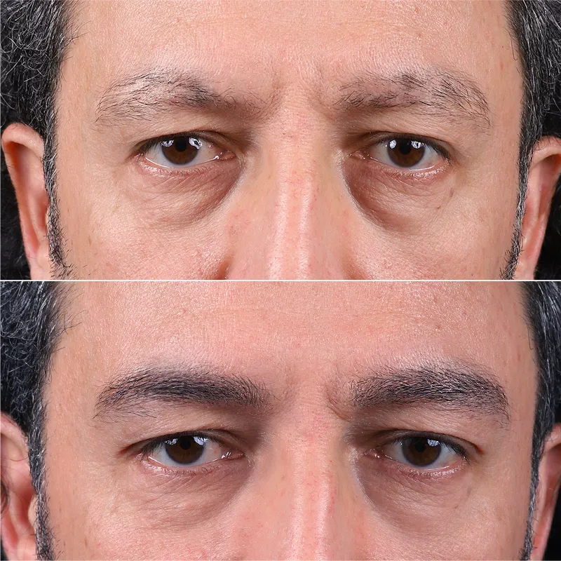Eyebrow Transplant for Men Everything You Need to Know