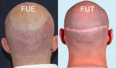 FUE vs FUT Hair Transplant Scars What’s the Difference