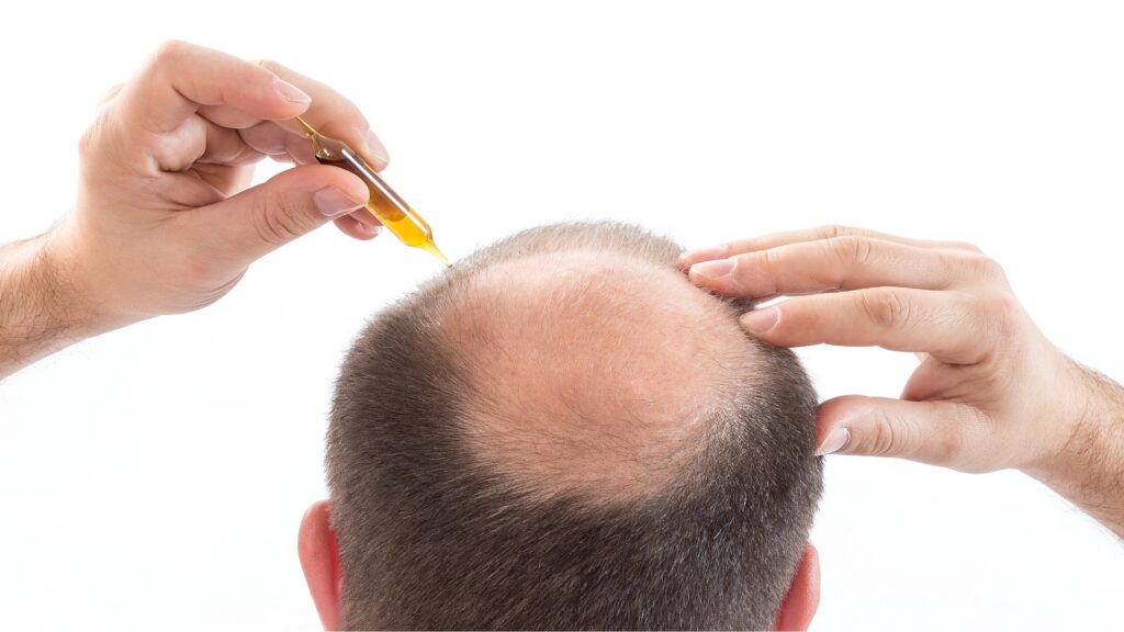 Worst Steroids for Hair Loss: What to Avoid and Why 1 Hair Cloning: A New Beginning in Hair Restoration! Is It a Reality?