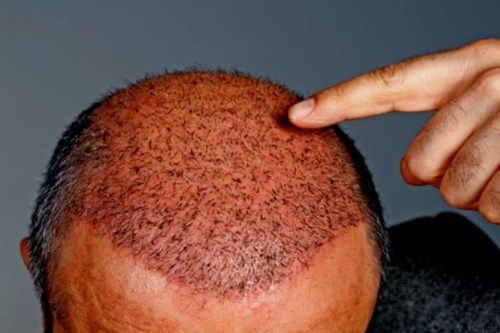 Hair Transplant Redness: Causes, Timeline & Expert Recovery Tips 2 Best Hair Transplant