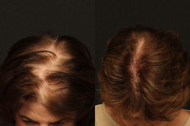 Natural Cure for Alopecia: Evidence-Based Remedies That Work 3 Hair Cloning: A New Beginning in Hair Restoration! Is It a Reality?