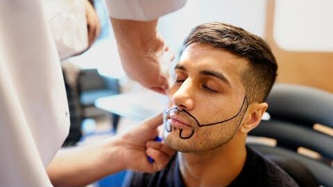 Beard to Scalp Transplant 1 How Beard Hair Transplants Work for Scalp Restoration