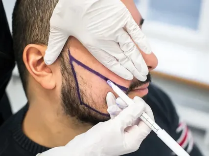 How Beard Hair Transplants Work for Scalp Restoration 1 How Beard Hair Transplants Work for Scalp Restoration