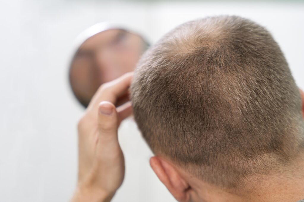 Top Medications for Alopecia Areata in 2025: What Works Best? 2 How Steroids Affect Hair Follicles