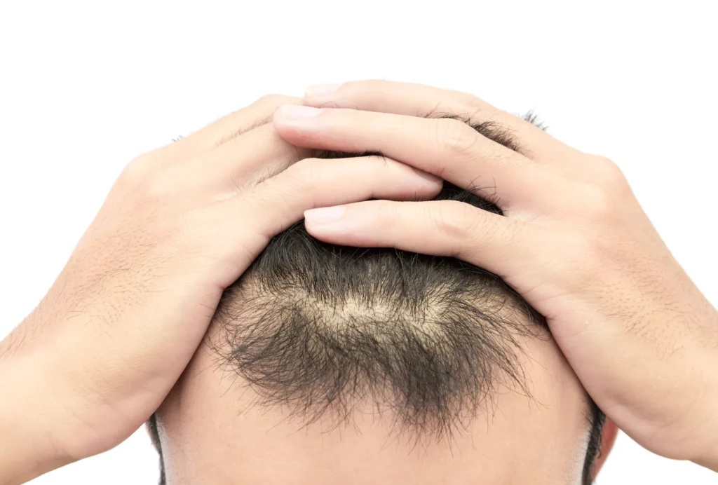 How to Stop Receding Hairline