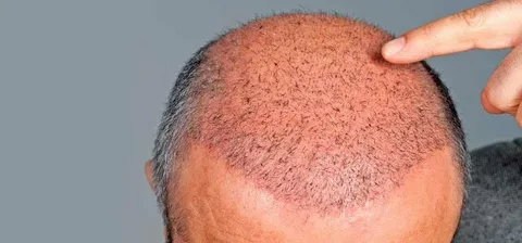 Is Pubic Hair Suitable for Hair Transplant on the Head? 1 Is Pubic Hair Suitable for Hair Transplant on the Head