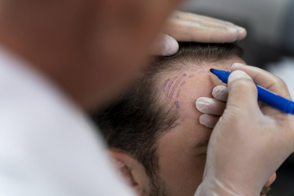 No-Shave FUE (Unshaven Hair Transplant)