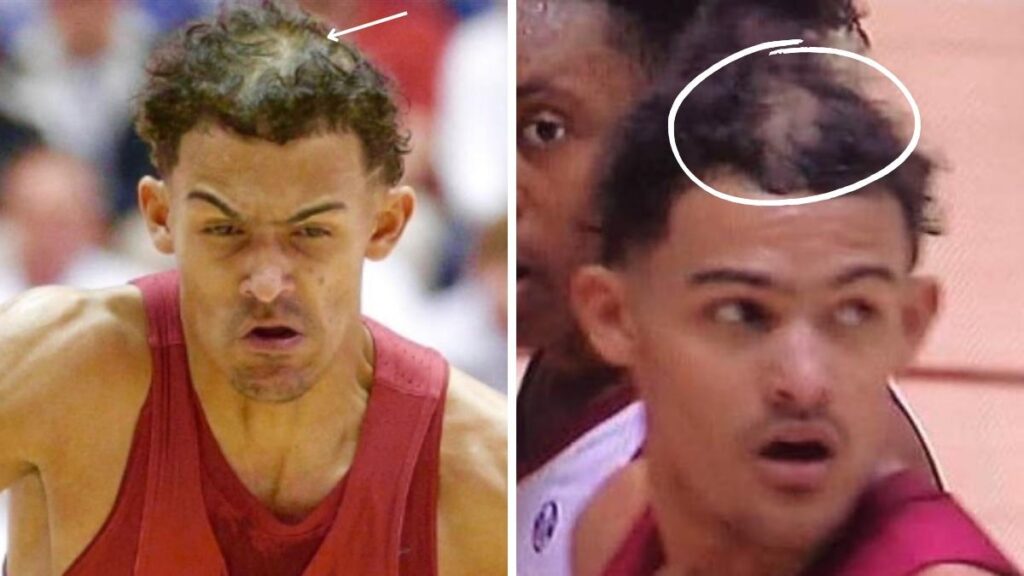 Trae Young Hair Loss: Has He Undergone a Hair Transplant? 1 Trae Young Hair Loss Has He Undergone a Hair Transplant