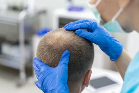 Can You Use Chest Hair as Donor Hair for the Scalp? 2 What Is the Best Age for a Hair Transplant