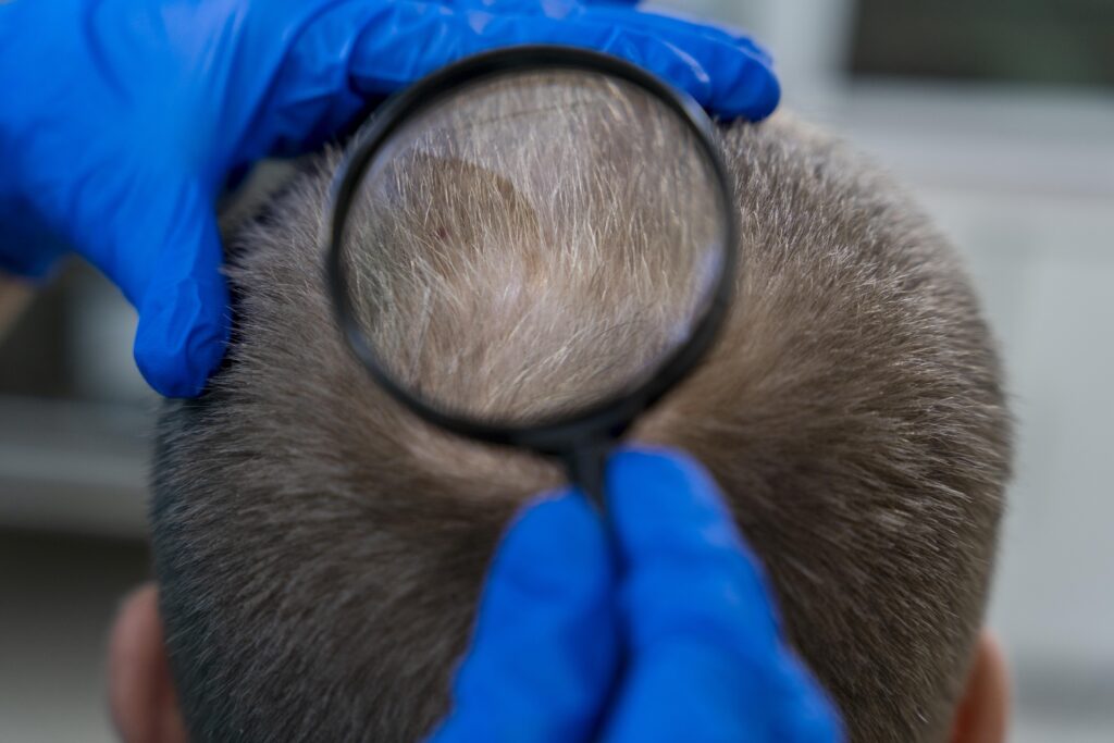 Hair Shedding vs Hair Loss in Males: What’s the Difference? 1 alopecia medication