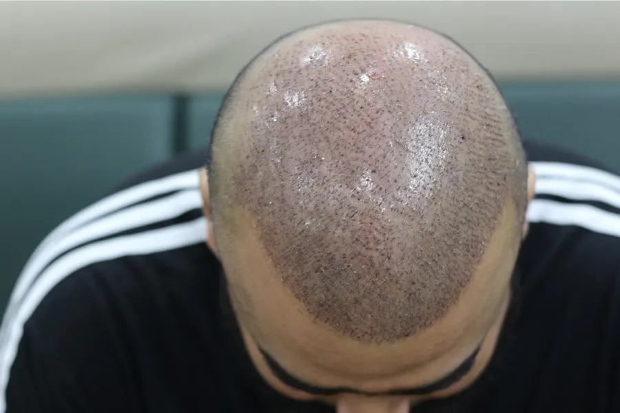 Where Is the Cheapest Place to Get a Hair Transplant? 2 hair transplant