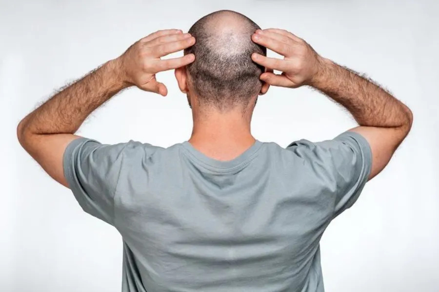 What Makes Hair Fall Out in Men? 1 hair-fall