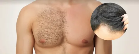 Can You Use Chest Hair as Donor Hair for the Scalp? 1 Can You Use Chest Hair as Donor Hair for the Scalp?