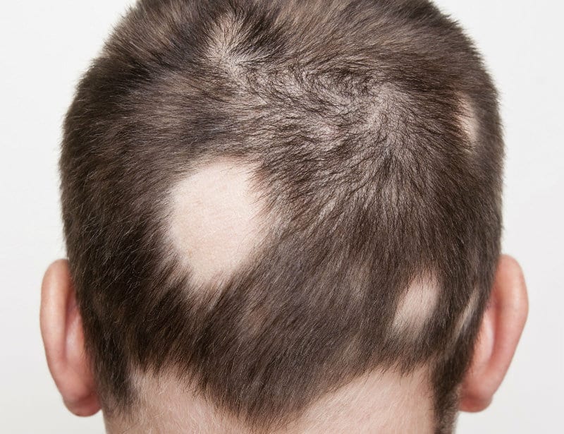 Effective Home Remedies for Alopecia: Natural Ways to Regrow Hair