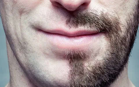 Beard Restoration: Expert Guide to Regain a Fuller Beard 3 Beard Restoration