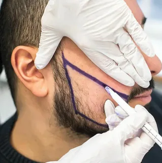 Beard to Scalp Transplant