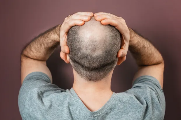 Do Fibroids Cause Hair Loss? Causes, Links & What You Can Do 2 Do Fibroids Cause Hair Loss