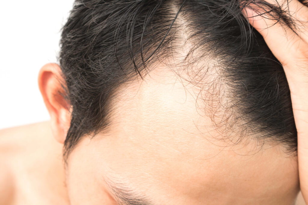 Male vs Female Hairline 2 FUE Scars