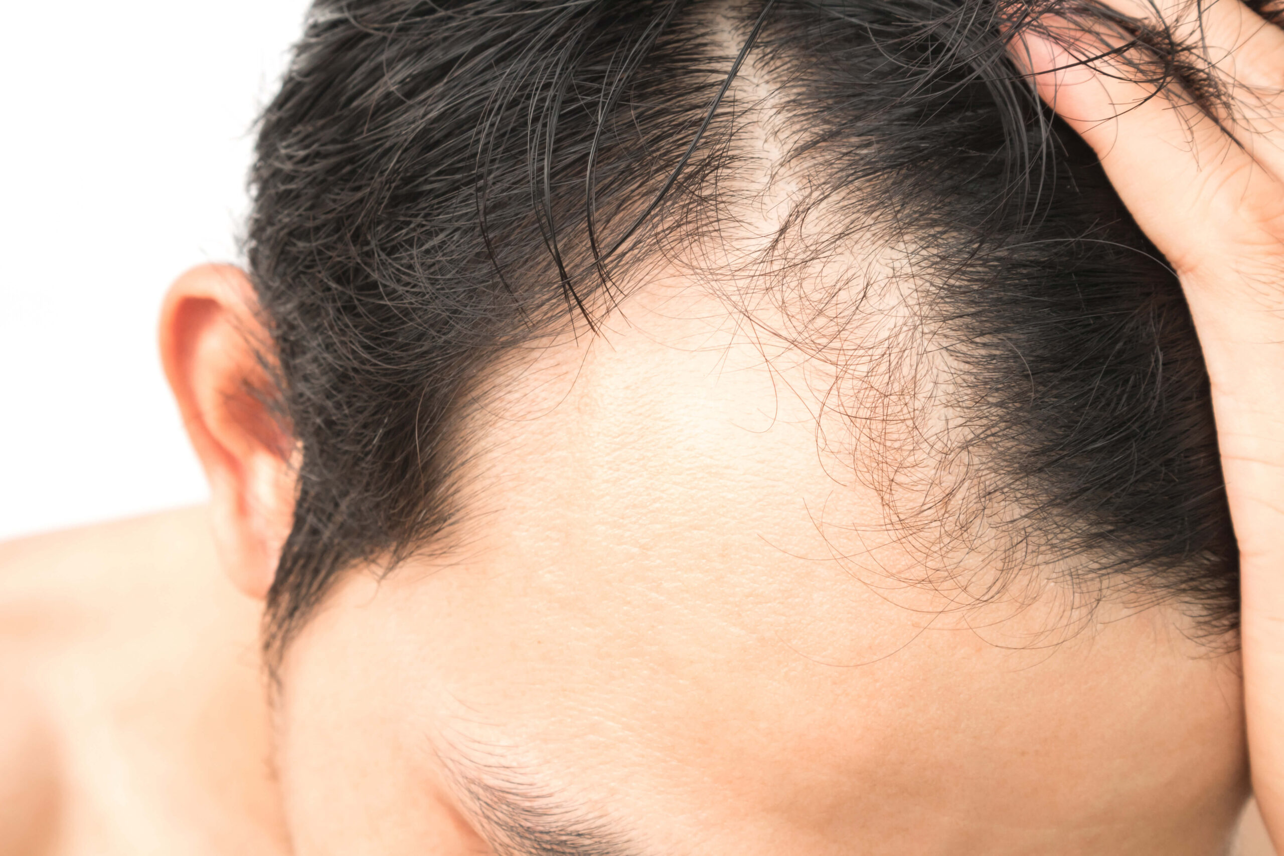 Hair Cloning: The Future of Hair Restoration