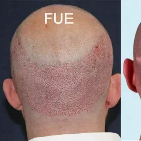 Exosomes for Hair Loss Before and After: What to Expect & Real Results 3 Exosomes for Hair Loss Before and After What to Expect & Real Results