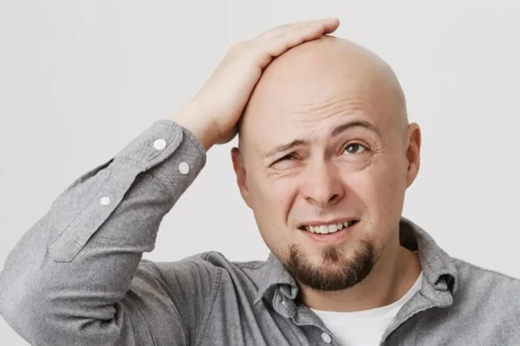 Grade 7 Baldness: Ultimate Guide 21 grade 7 baldness