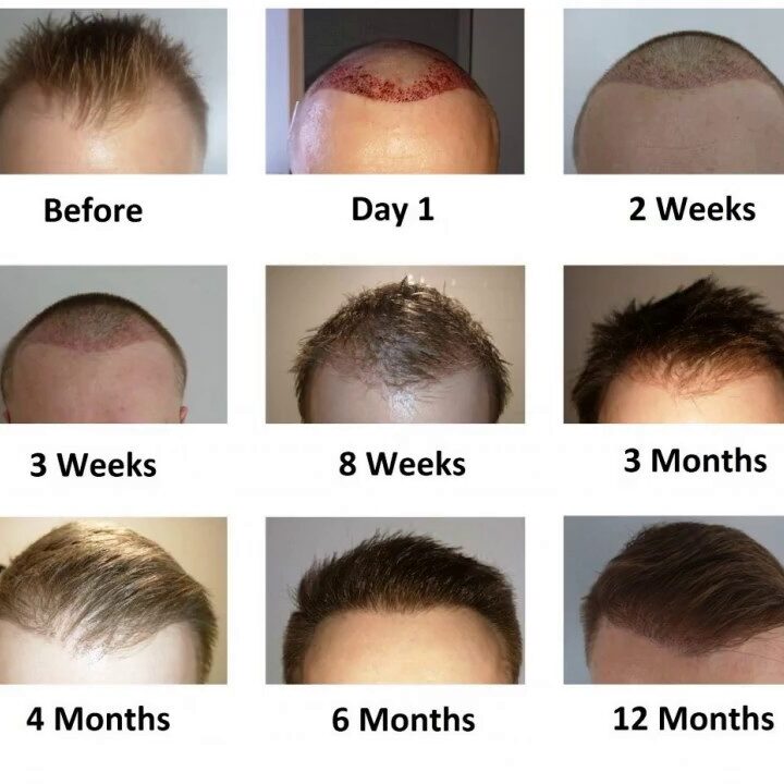 Hair Transplant Redness: Causes, Timeline & Expert Recovery Tips 1 Hair Transplant Redness