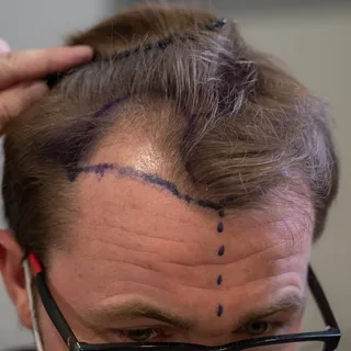 Can Chest Hair Be Used for Hair Transplant? 1 Hair Transplant Trypophobia