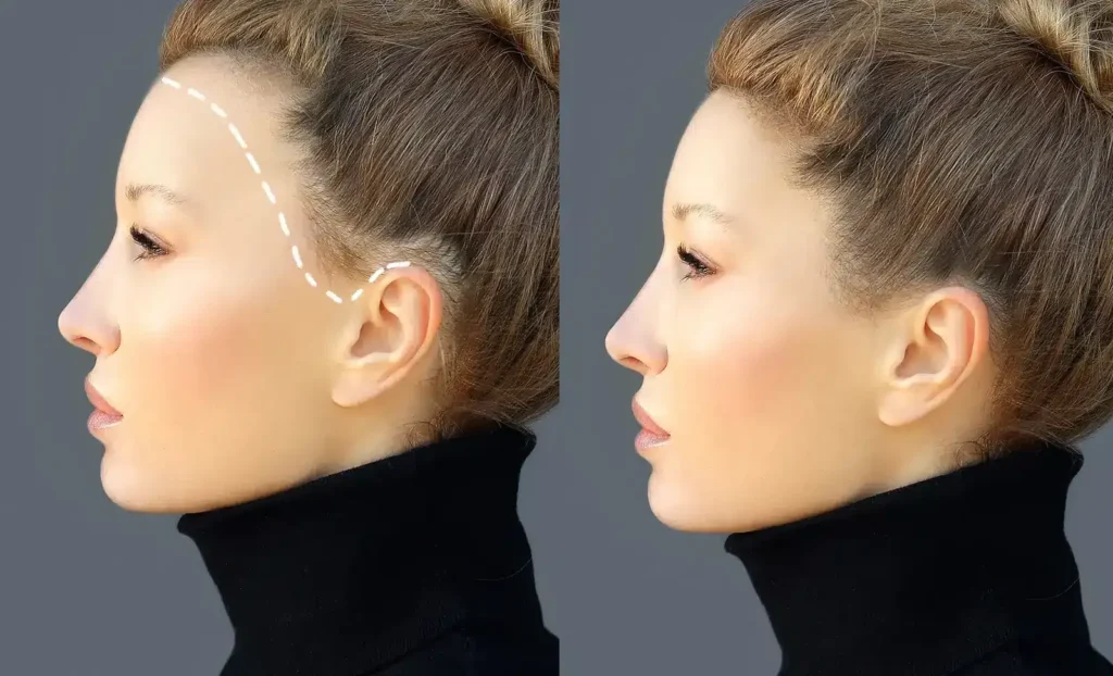 Hairline Lowering Surgery Scar: What to Expect & How to Minimize It 1 Hairline Lowering Surgery Scar
