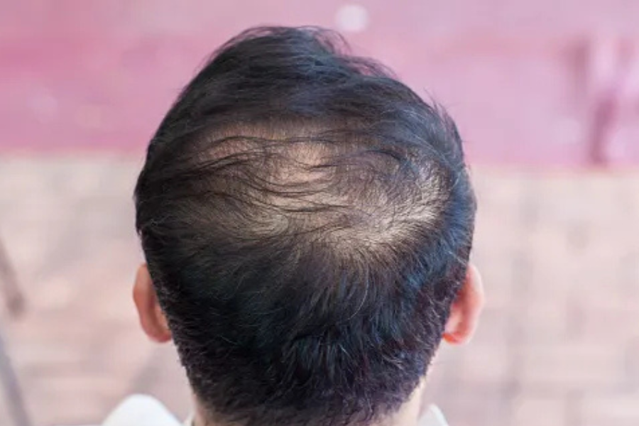 Where Do Hair Transplants Come From? Origins, Sources & Medical Insights 3 where do hair transplants come from