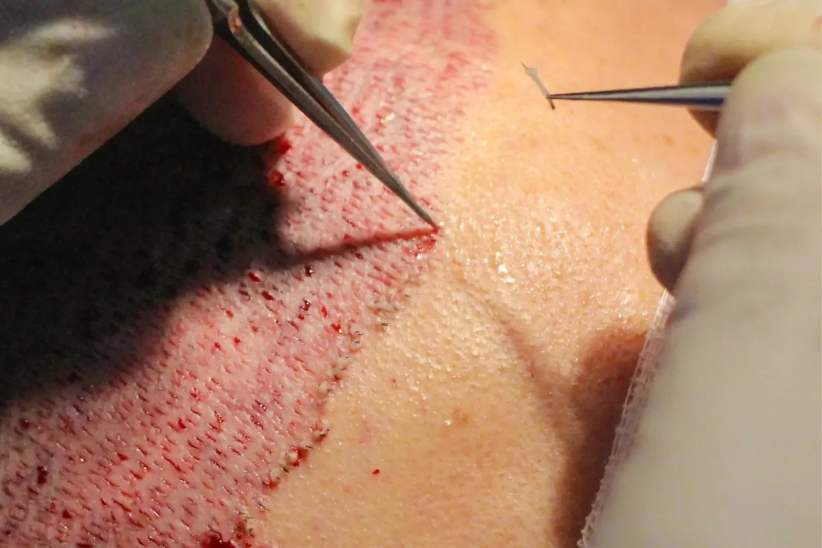 Top 5 Hair Transplant Clinics in the World: Ultimate Guide for 2025