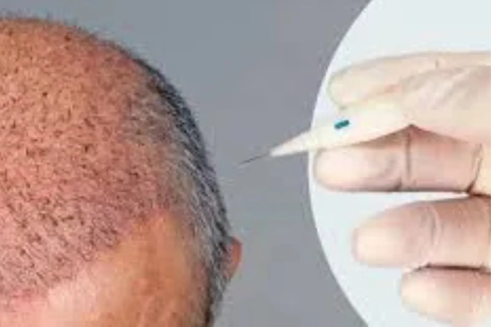 The Complete Guide to Afro Hair Transplant 4 afro hair transplant