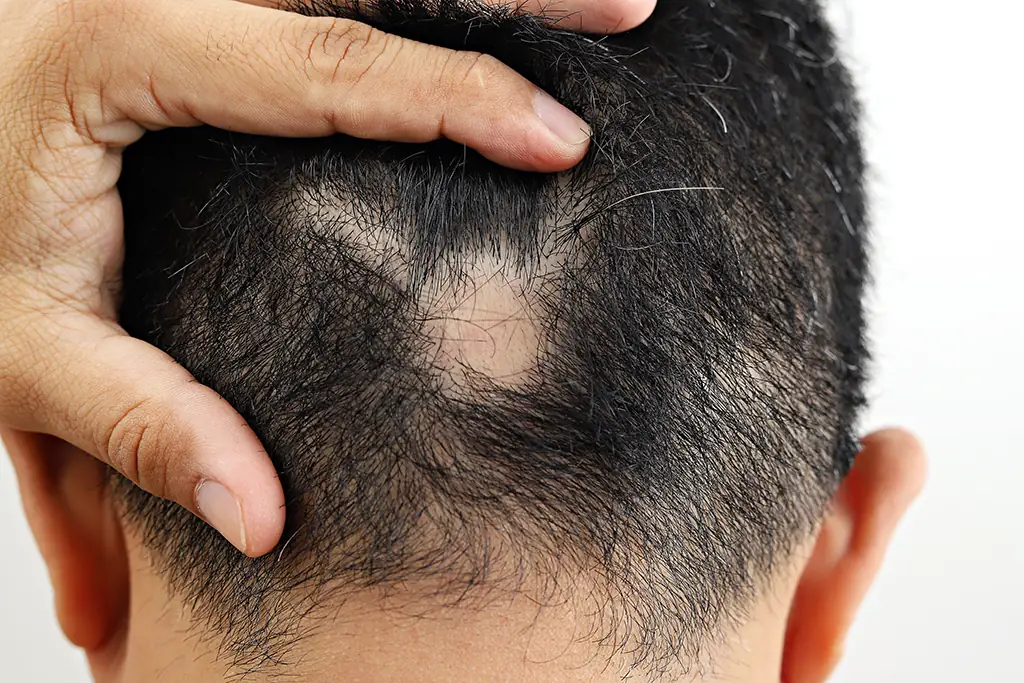 What Is the Difference Between Male and Female Pattern Baldness