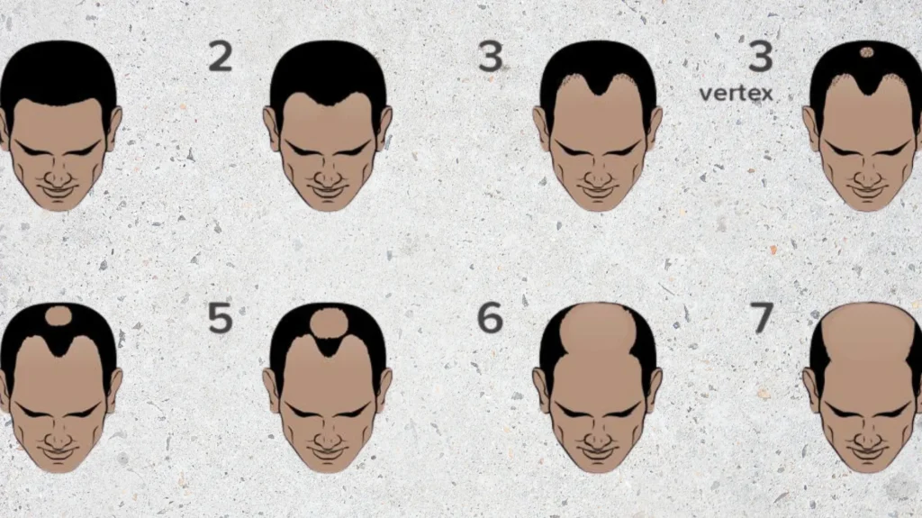 Grade 7 Baldness: Ultimate Guide 3 grade 7 baldness