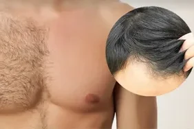 Can Hair Be Transplanted from Body to Head? 3 Can You Use Chest Hair as Donor Hair for the Scalp?