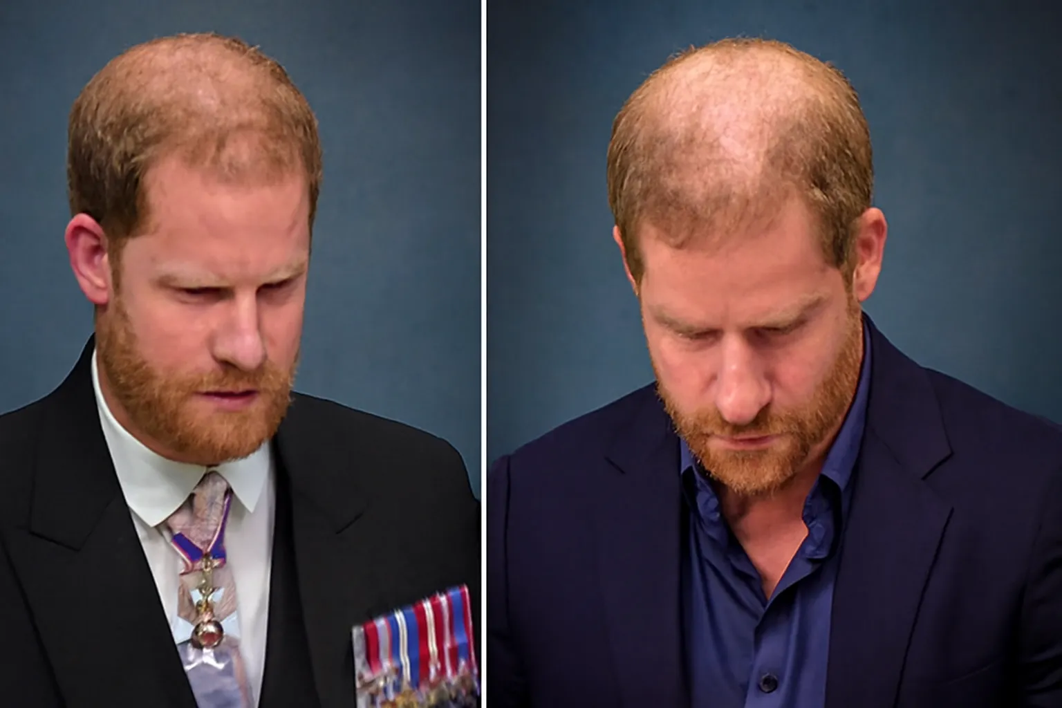Prince Harry Hair Loss: What’s Really Happening and Why It Matters