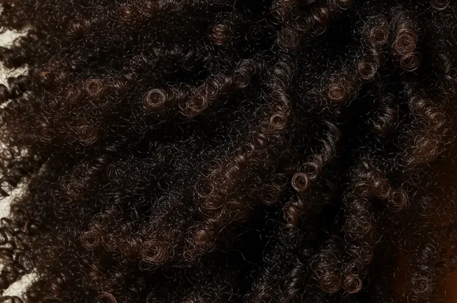 afro hair transplant (3) Afro Hair Transplant